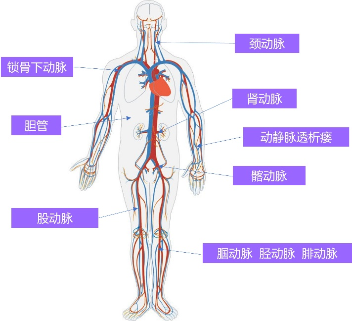 周游? Voyaging?球囊擴張導管(圖3)